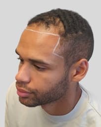 hairline with less hair