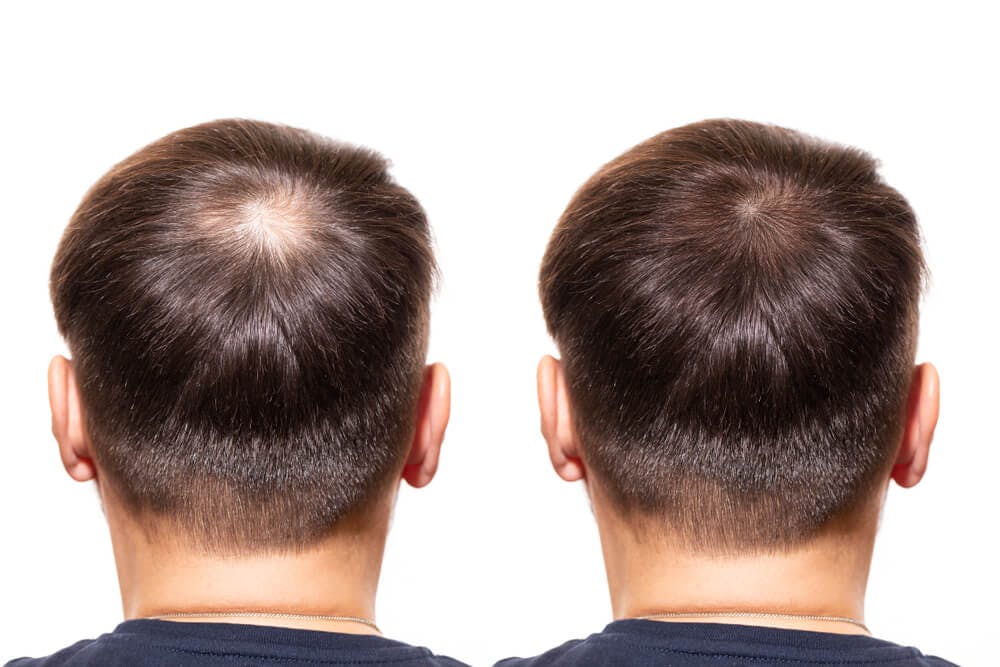 relæ Shuraba Predictor Minoxidil Hair Loss Treatment | Mosh